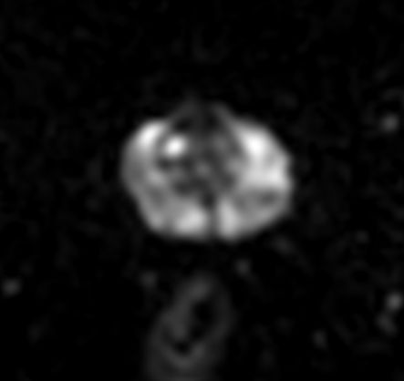 Axial DWI b100<b>Gradient strength: Maximum</b>