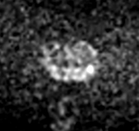 Axial DWI b1500<b>Gradient strength: Maximum</b>