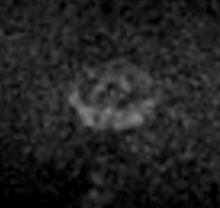 Axial DWI b2000<b>Gradient strength: Maximum</b>