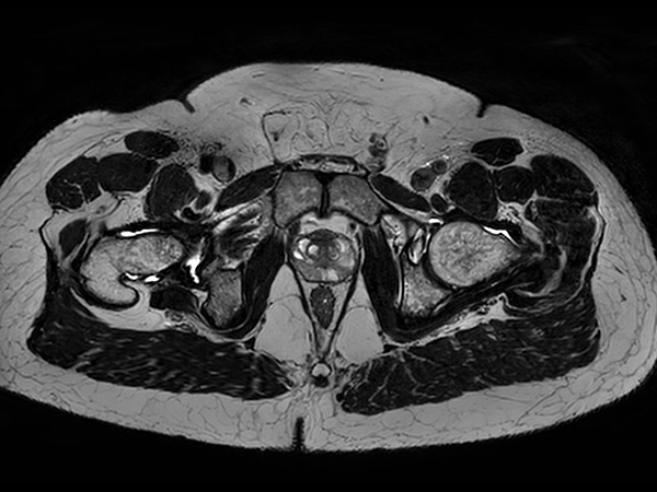 Axial 3D T2w TSE (PelvisVIEW)