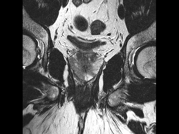 Coronal T2w TSE