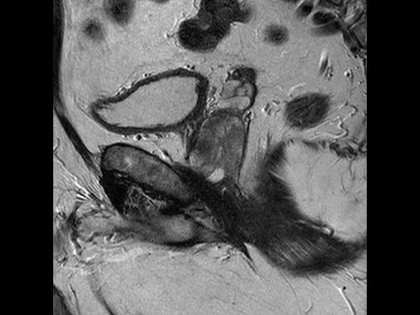 Sagittal T2w TSE