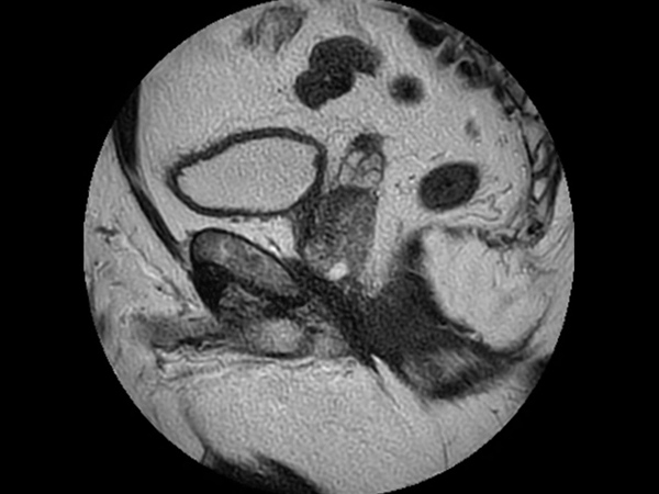 Sagittal T2w TSE MultiVane XD