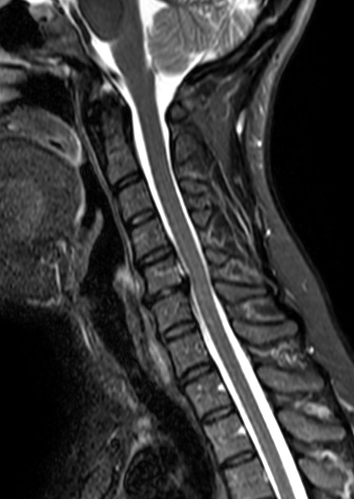 Sagittal STIR TSE