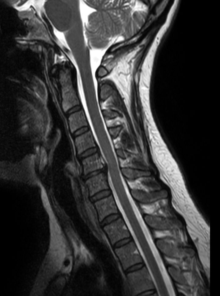 Sagittal T2w TSE mDIXON XD<b>In phase</b>