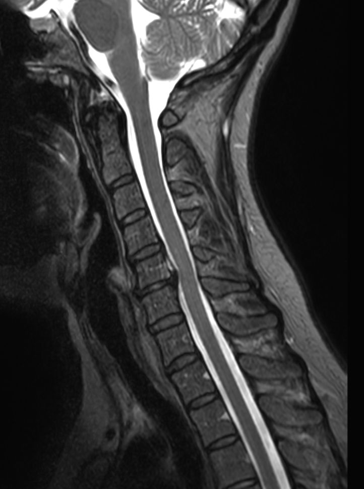 Sagittal T2w TSE mDIXON XD<b>Partial FatSat</b>
