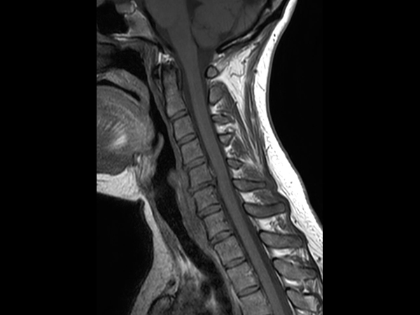 Sagittal T1w TSE