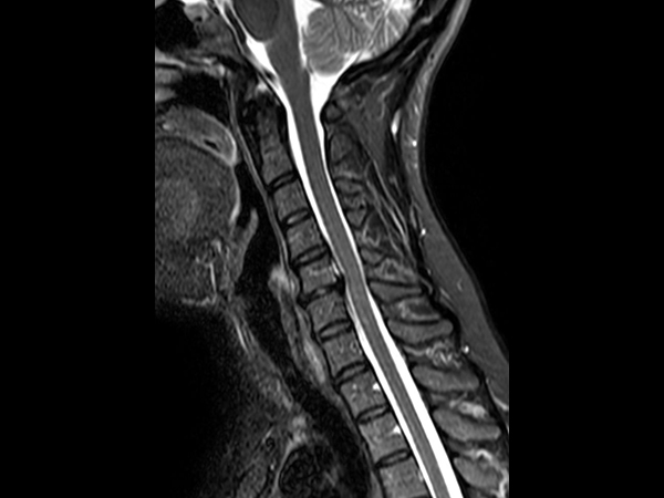 Sagittal STIR TSE