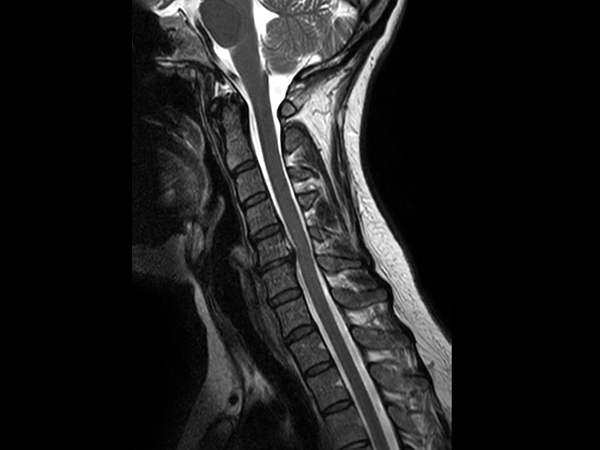 Sagittal T2w TSE mDIXON XD<b>In phase</b>