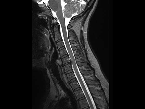 Sagittal T2w TSE mDIXON XD<b>Partial FatSat</b>