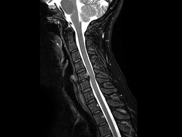 Sagittal T2w TSE mDIXON XD<b>Water only</b>