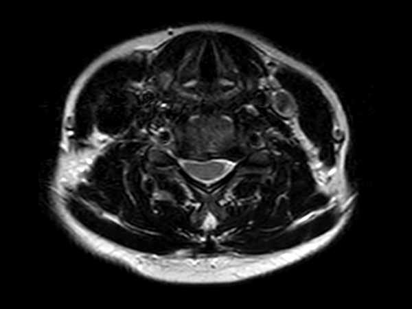 Axial T2w TSE