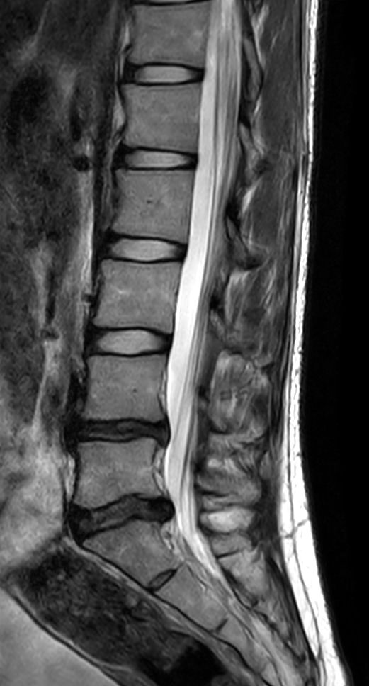 Sagittal T2w TSE