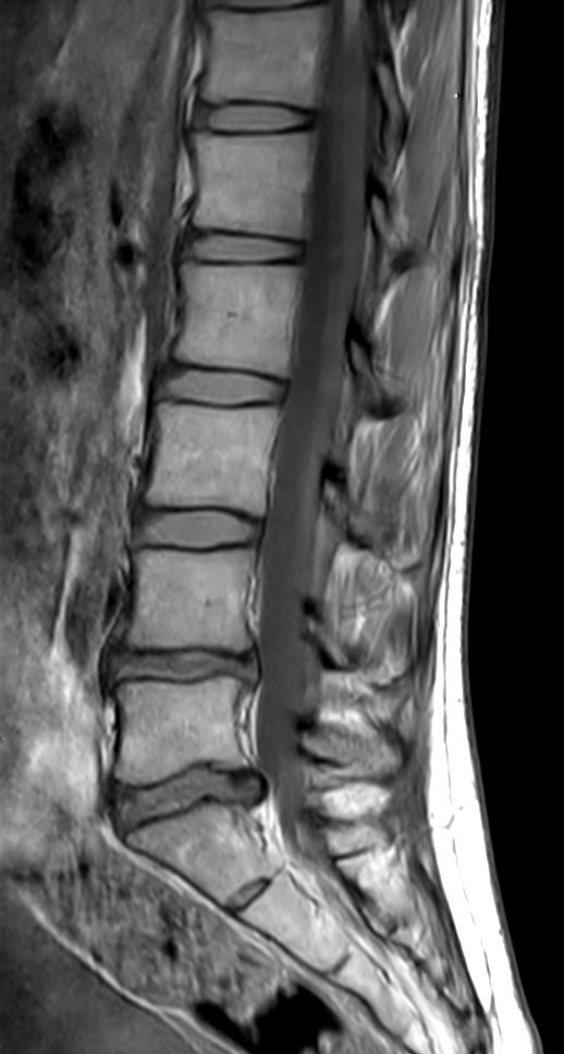 Sagittal PDw TSE