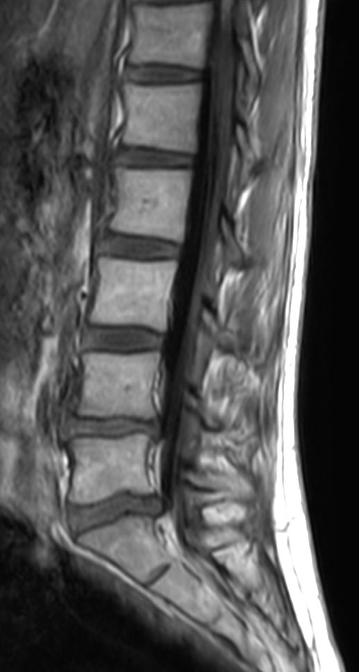 Sagittal T1w FLAIR