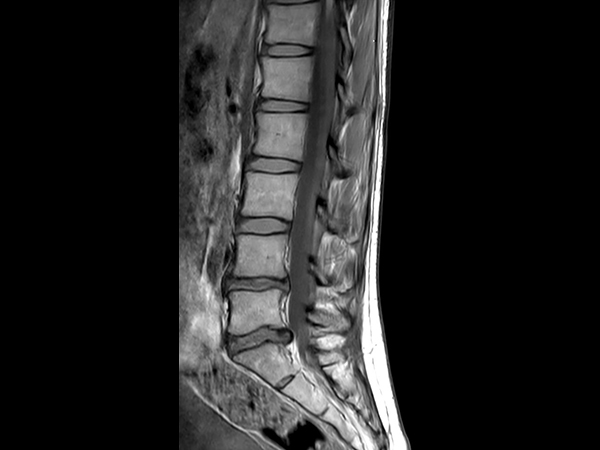 Sagittal PDw TSE