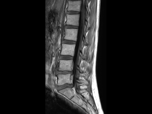 Sagittal T1w FLAIR