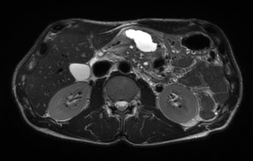 Axial T2w TSE MultiVane XD