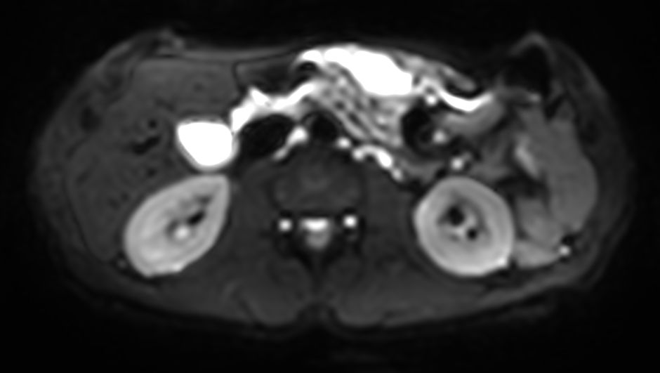 Axial DWI b50<b>4mm slices</b>