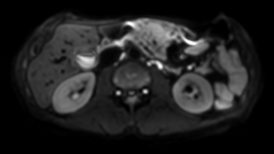 Axial DWI b600<b>4mm slices</b>