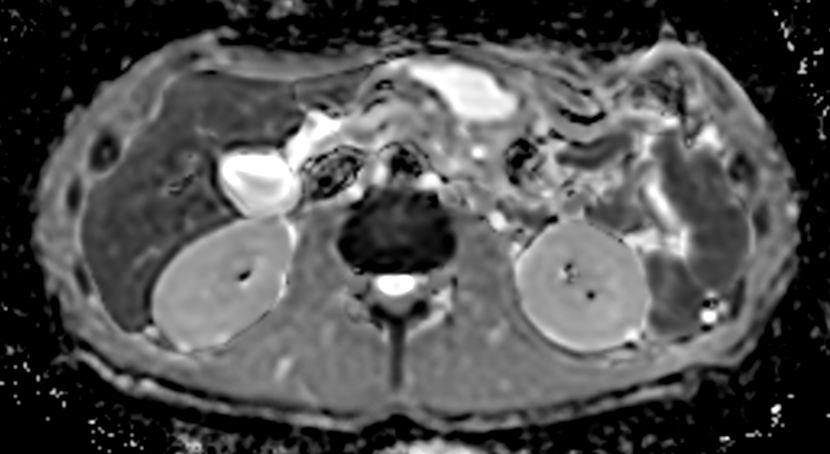 Axial DWI ADC<b>4mm slices</b>