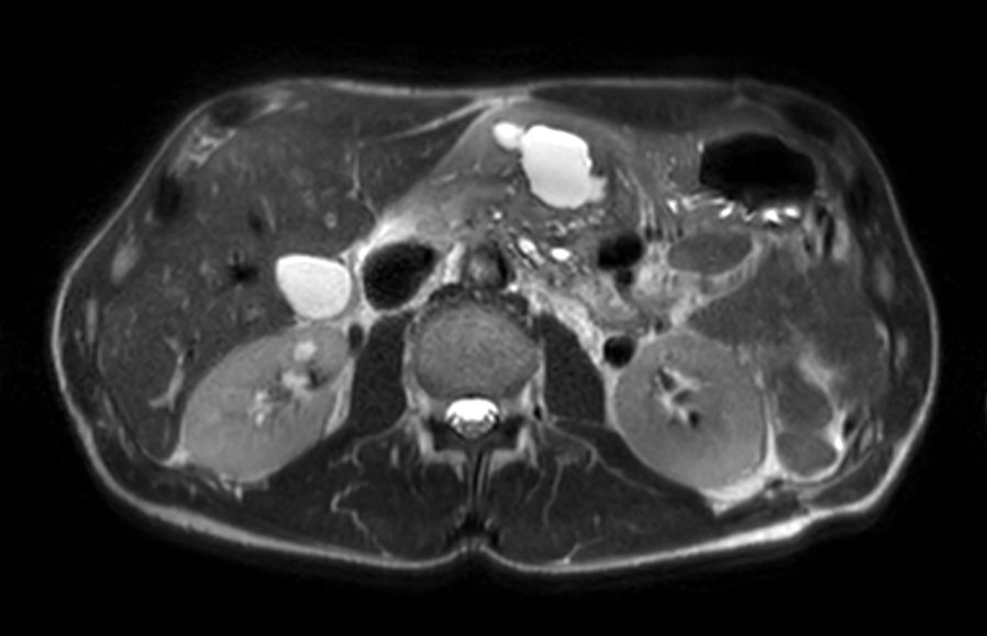 Axial T2w TSE single shot