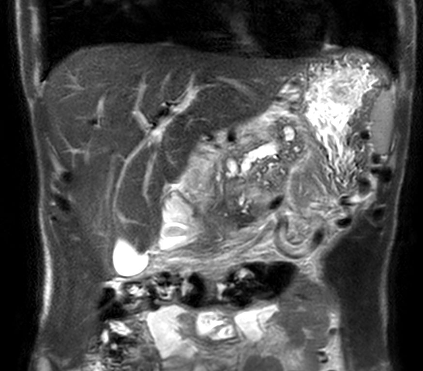 Coronal T2w TSE single shot