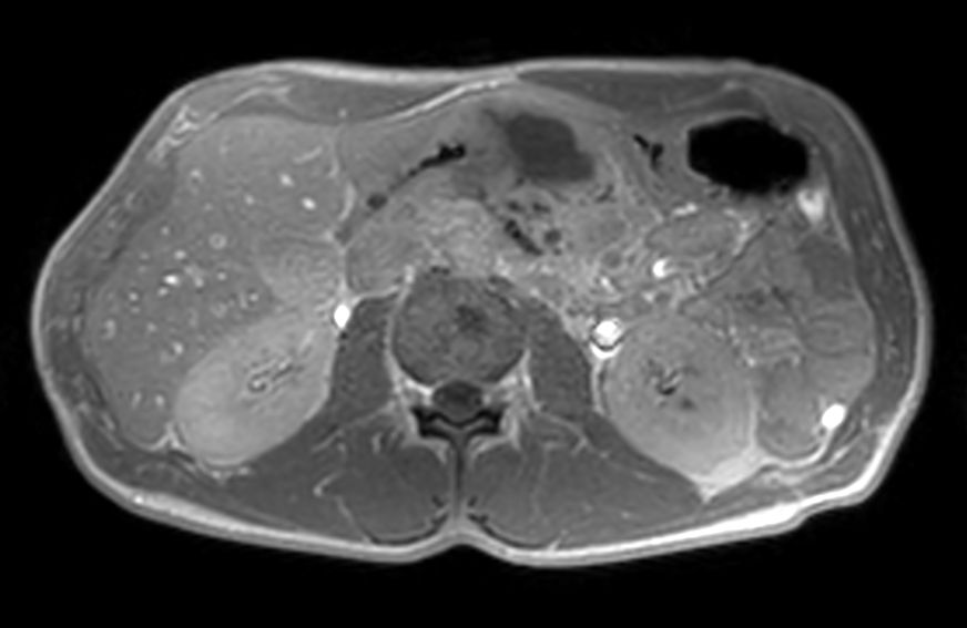 Axial T1w Dual FFE<b>In phase</b>