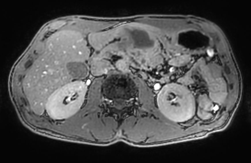 Axial T1w Dual FFE<b>Out phase</b>
