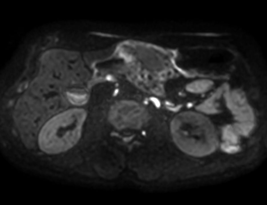 Axial DWI b1000<b>3mm slices</b>