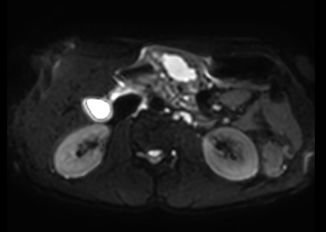 Axial DWI b50<b>3mm slices</b>