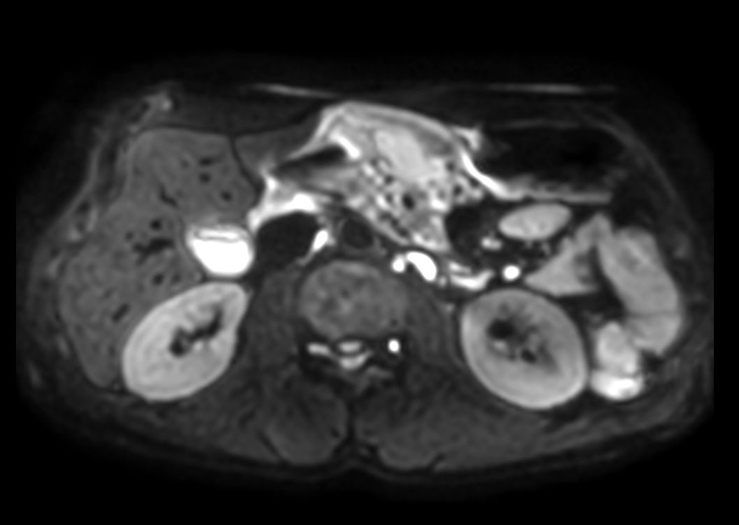 Axial DWI b600<b>3mm slices</b>