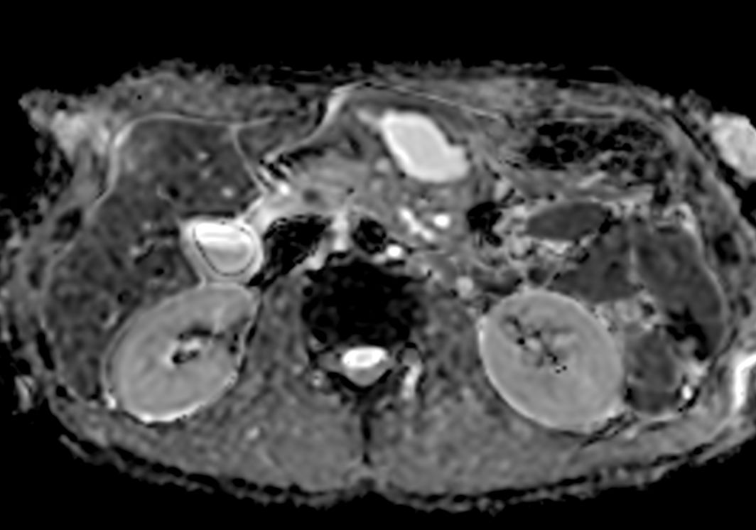 Axial DWI ADC<b>3mm slices</b>