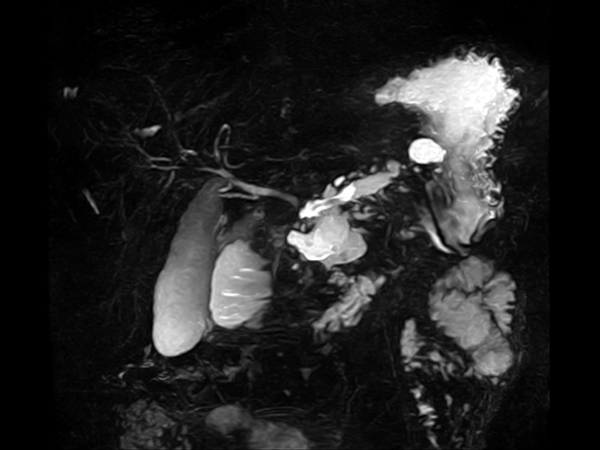 Coronal 3D MRCP<b>Breath hold</b>