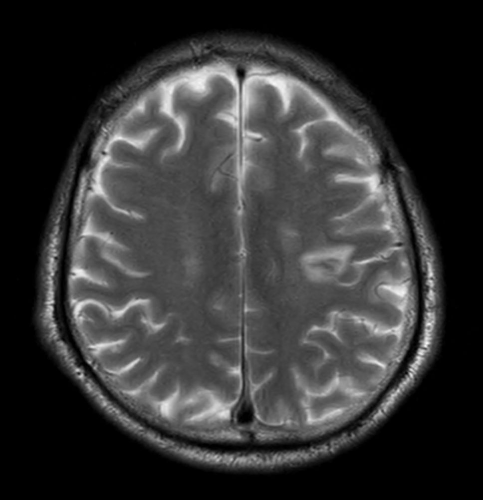 Axial T2w TSE - Compressed SENSE