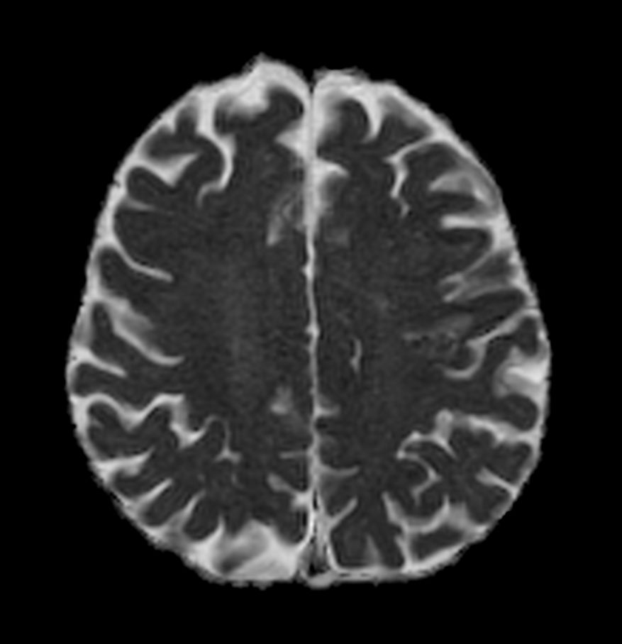 Axial DWI EPI (ADC) - High resolution