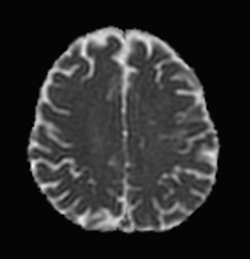 Axial DWI TSE XD (ADC)