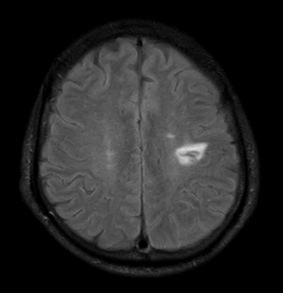 Axial T2w FLAIR - Compressed SENSE