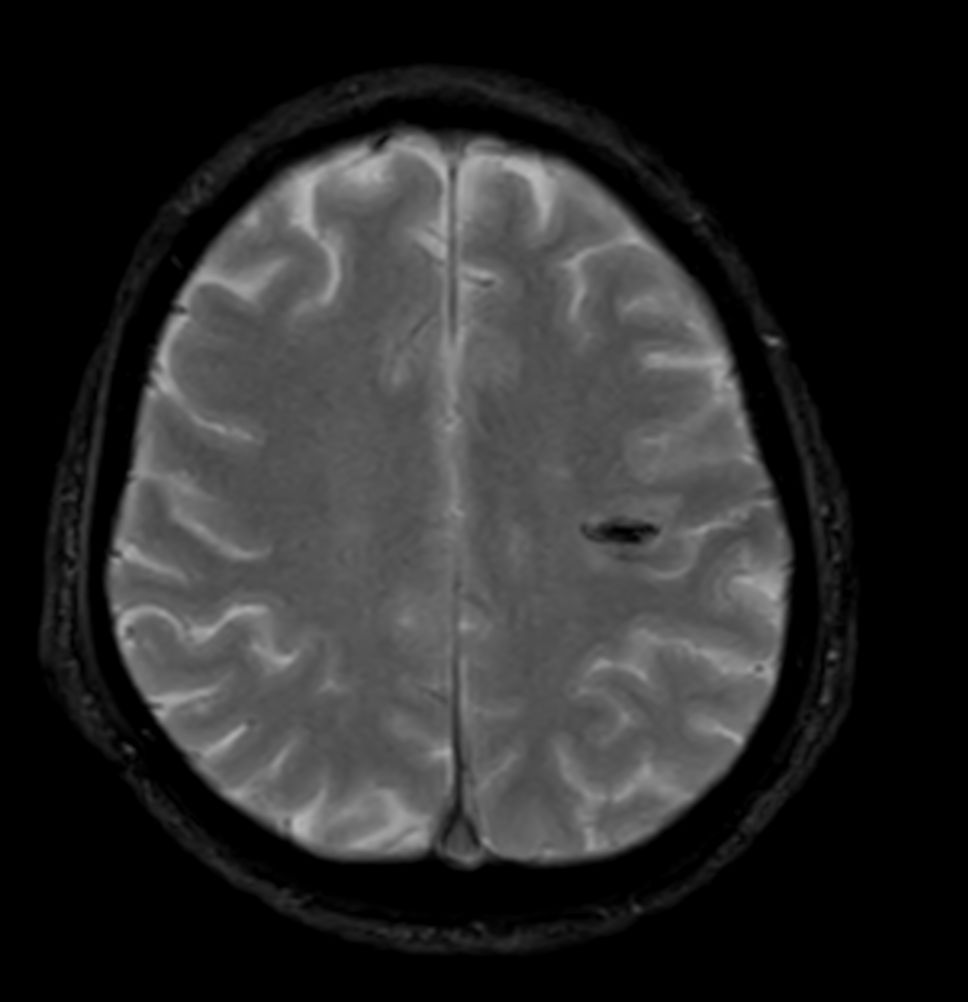 Axial T2* FFE - Compressed SENSE