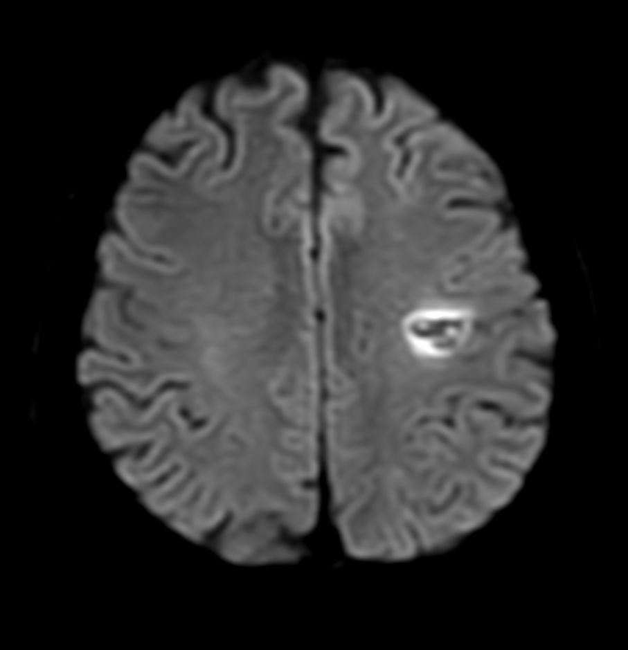 Axial DWI EPI (b1000)