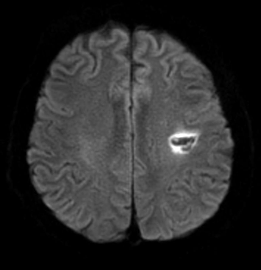 Axial DWI EPI (b1000) - High resolution