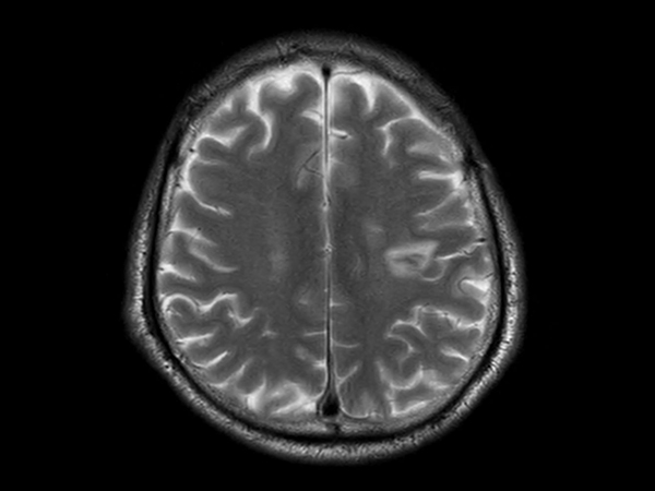 Axial T2w TSE - Compressed SENSE