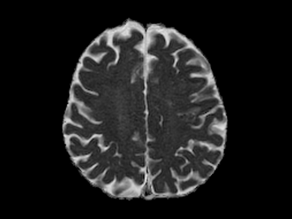 Axial DWI EPI (ADC) - High resolution