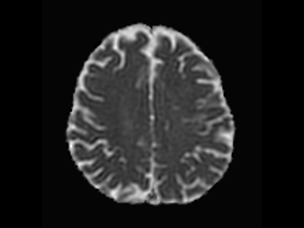 Axial DWI TSE XD (ADC)