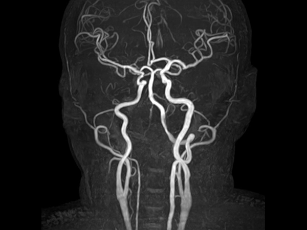 Coronal TOF (MIP)