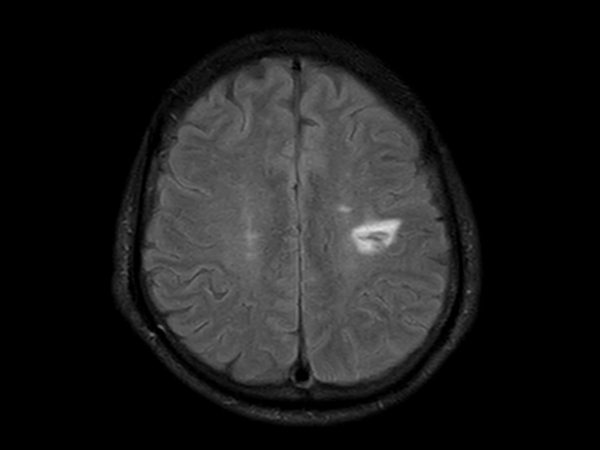 Axial T2w FLAIR - Compressed SENSE