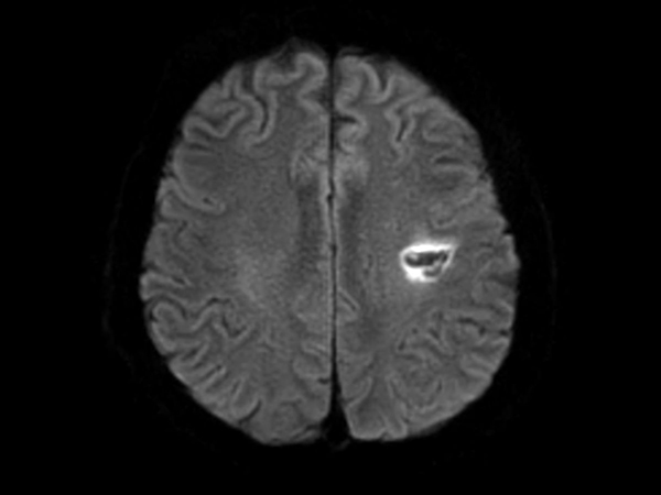 Axial DWI EPI (b1000) - High resolution