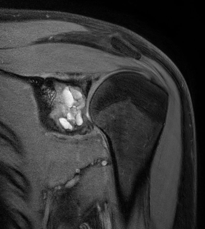 Coronal T1w mDIXON XD TSE - Compressed SENSE (Water only)