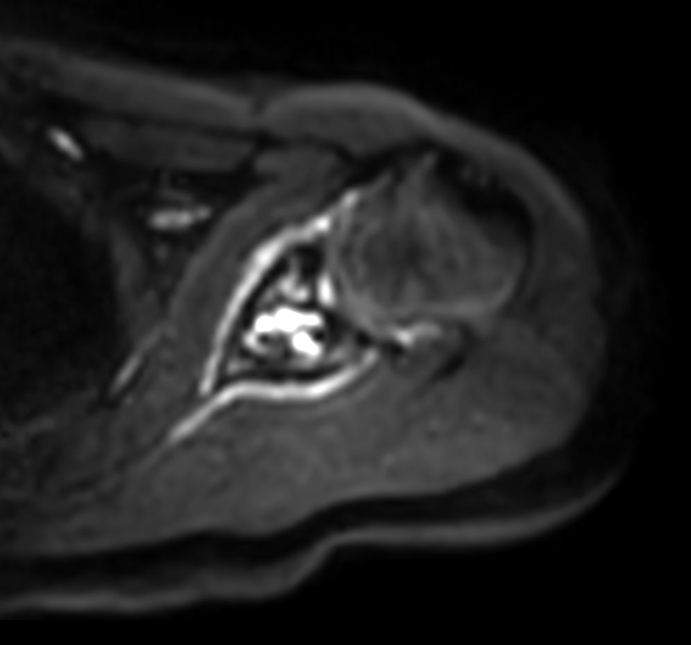 Axial DWI EPI (b500) - High resolution