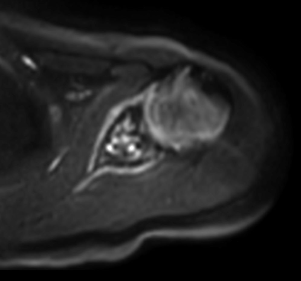 Axial DWI EPI (b1000) - High resolution